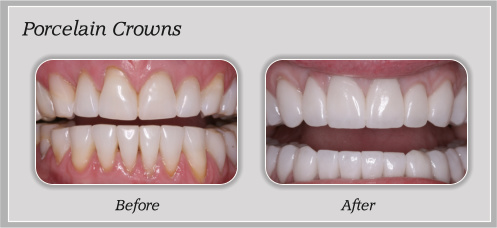 Porcelain Crowns In Bangalore